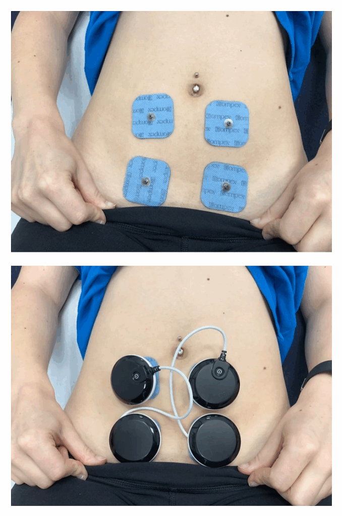 Diastasis Recti Abdominis (“Mummy Tummy”) 2 db249c c879c3b5052e4fc595cb6c82f5e98f7emv2
