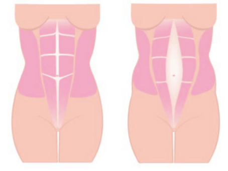 Diastasis Recti Abdominis (“Mummy Tummy”)